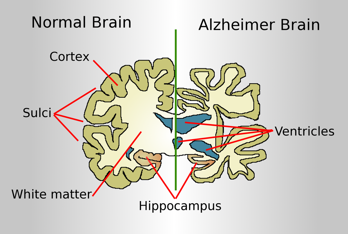 The difference between normal brain and Alzheimer brain